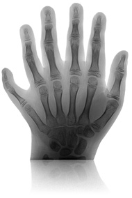 Polydactylie