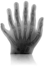 Polydactylie